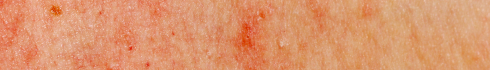 red_spots_skin